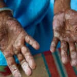Qué Dice La Biblia Sobre La Lepra: Significado E Historia